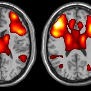 How the use of brain imaging is furthering our understanding of Lupus