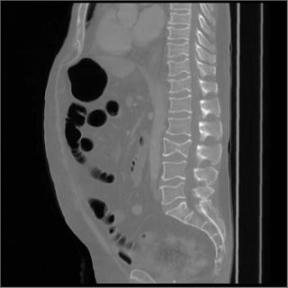 Manchester researchers secure funding to develop a tool to identify fractures associated with osteoporosis