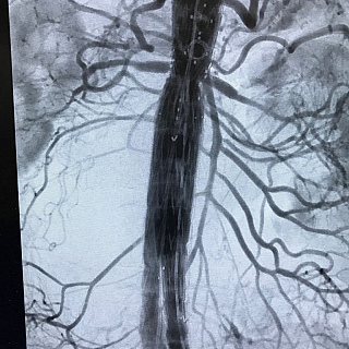Manchester-designed Arterial Sheath could improve surgical outcomes for patients with complex aortic aneurysms