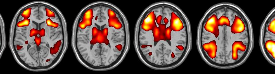 How the use of brain imaging is furthering our understanding of Lupus