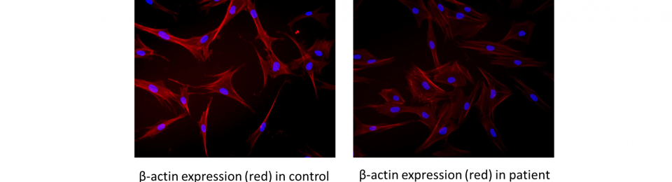 Disease caused by reduction of most abundant cellular protein identified