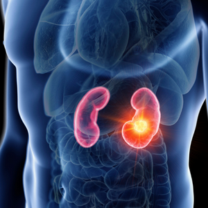 Kidney disease probably caused by obesity, find scientists